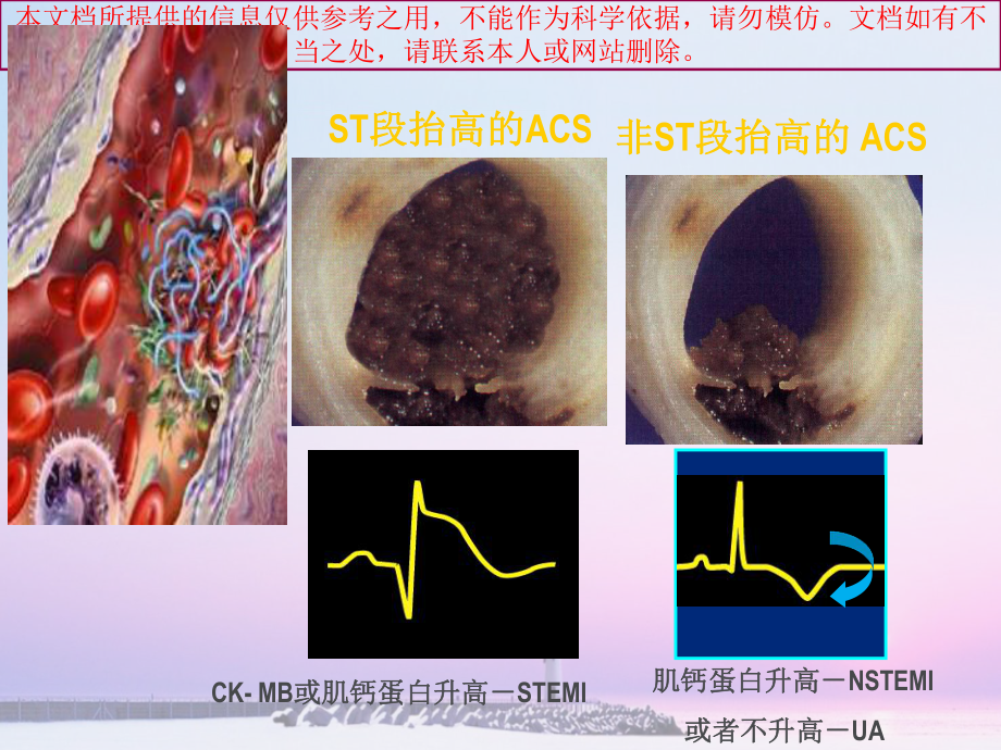 急性冠脉综合征的护理培训课件.ppt_第3页