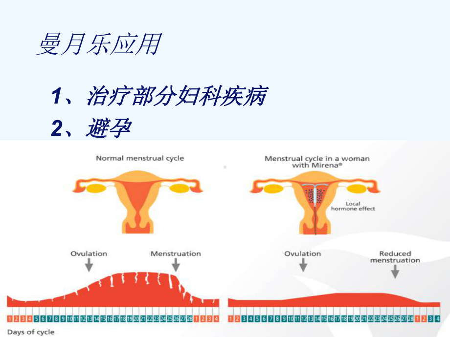 曼月乐临床应用课件.ppt_第2页