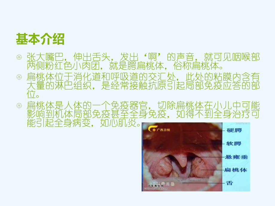 扁桃体术后的护理课件.ppt_第2页