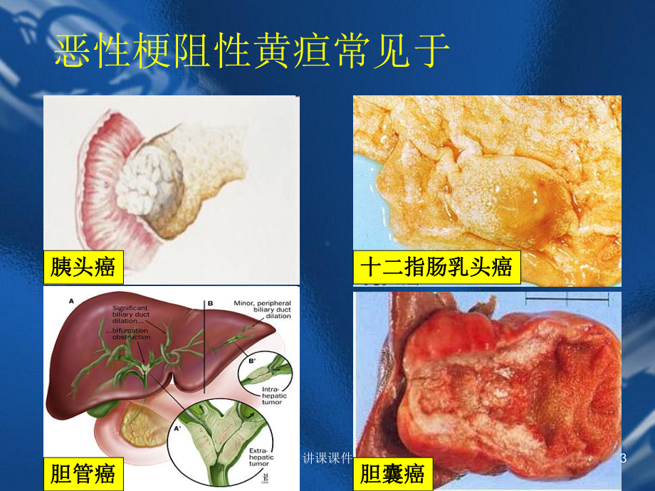 恶性梗阻性黄疸(行业特制)课件.ppt_第3页