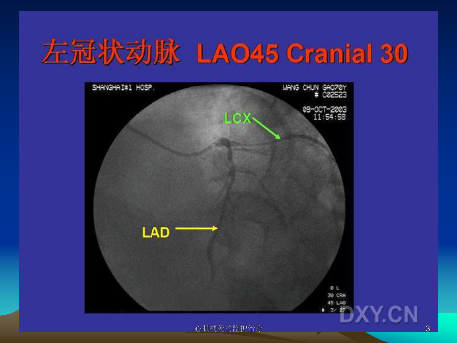 心肌梗死的监护治疗课件.ppt_第3页