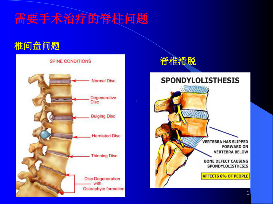 手术室护理查房脊柱手术麻醉课件.ppt_第2页