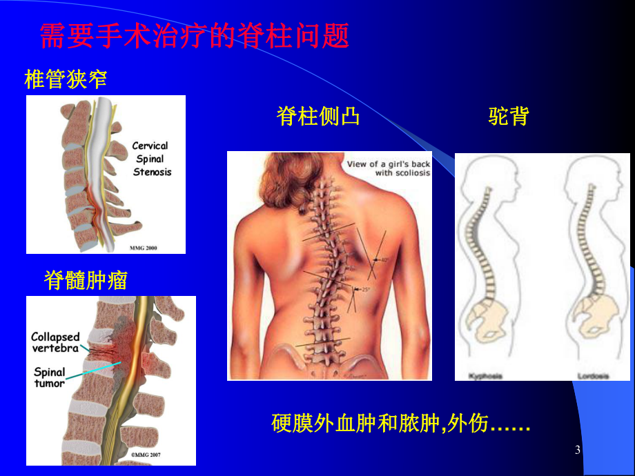 手术室护理查房脊柱手术麻醉课件.ppt_第3页