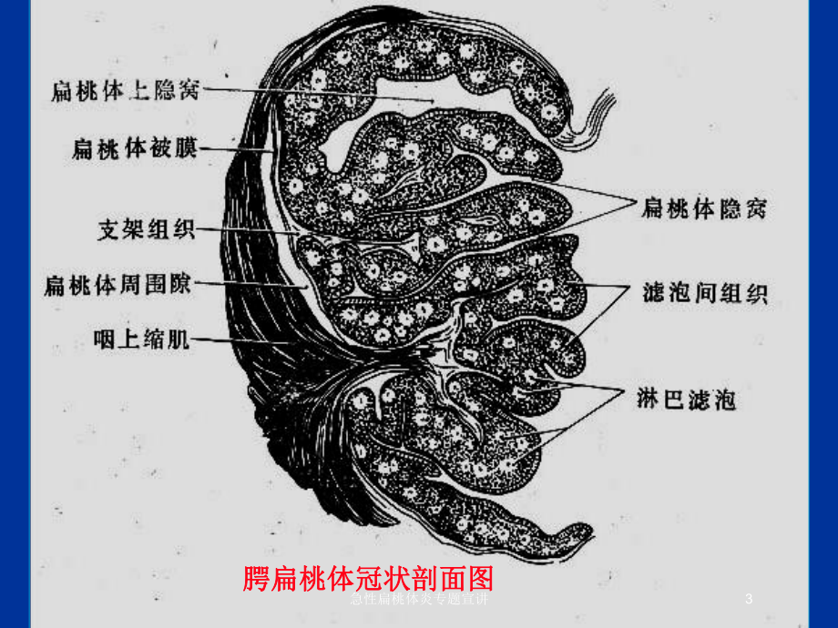 急性扁桃体炎专题宣讲培训课件.ppt_第3页