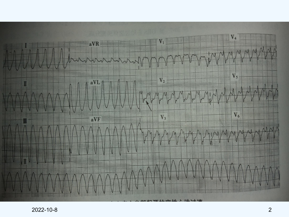 急重症心电图的快速识别及治疗课件.ppt_第2页