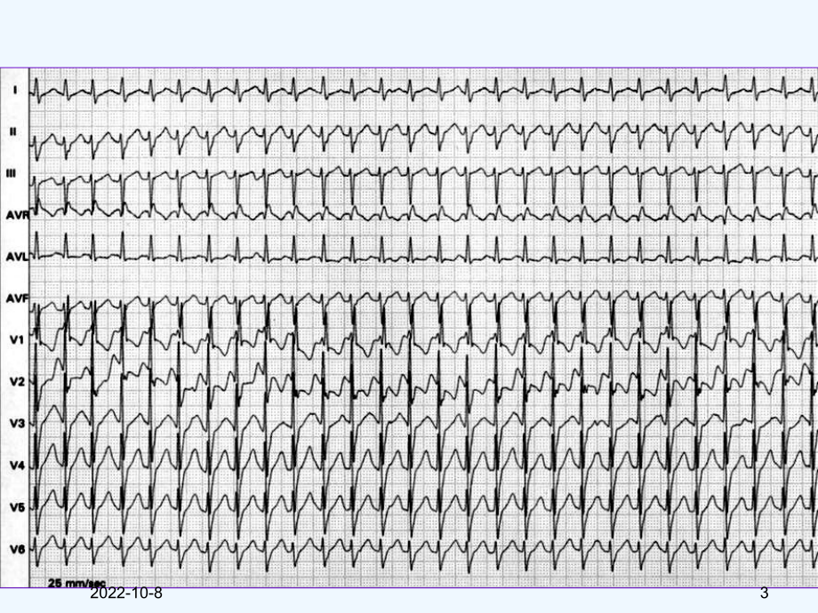 急重症心电图的快速识别及治疗课件.ppt_第3页