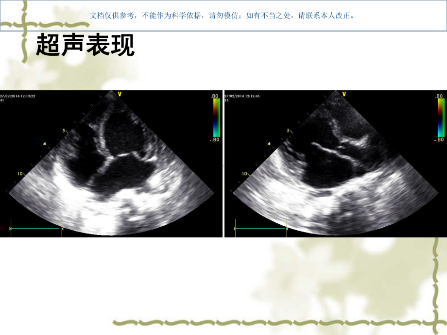 心肌病的超声表现课件.ppt_第2页