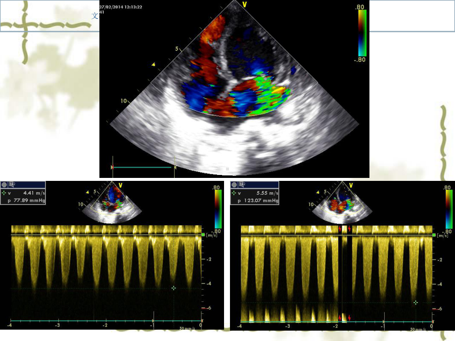 心肌病的超声表现课件.ppt_第3页