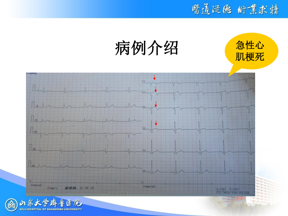 急性心肌梗死阴红红课件.ppt_第3页