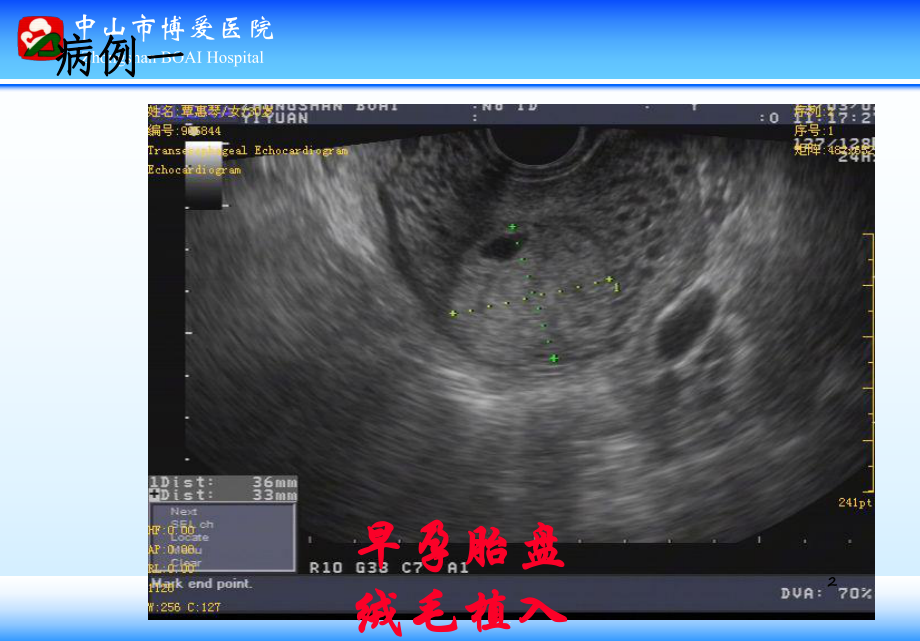 早孕胎盘绒毛植入培训课件.ppt_第2页