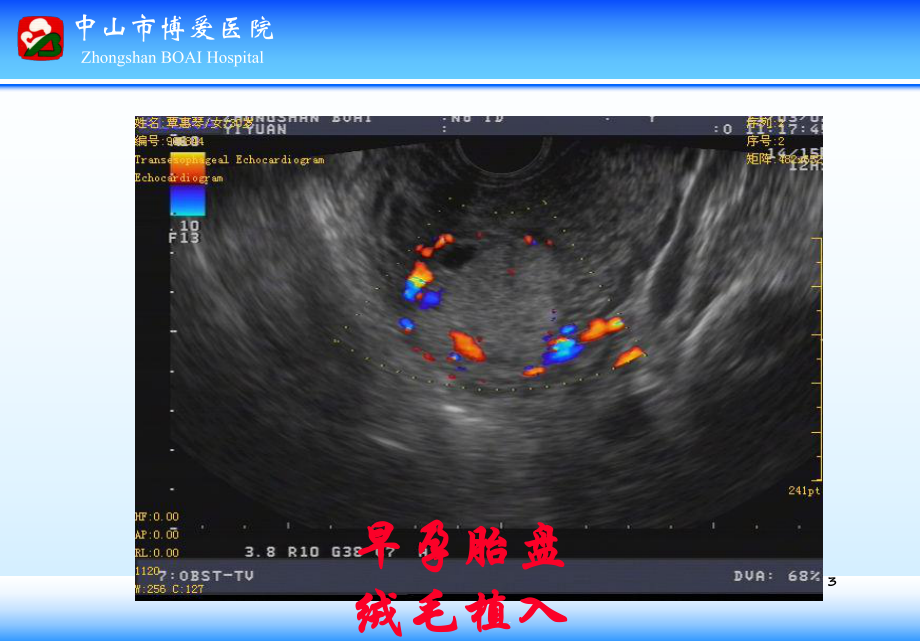 早孕胎盘绒毛植入培训课件.ppt_第3页