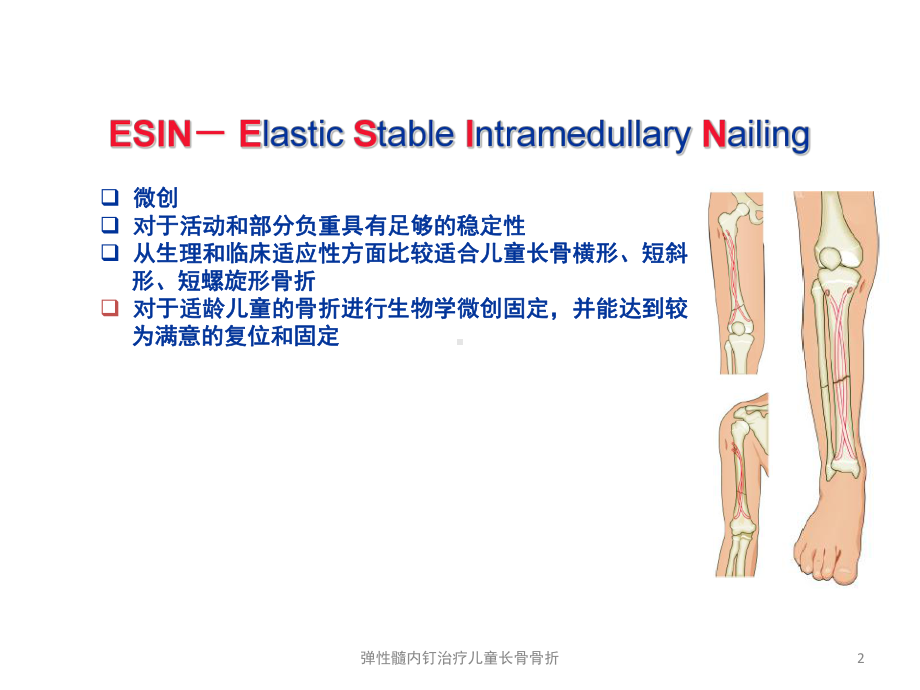 弹性髓内钉治疗儿童长骨骨折培训课件.ppt_第2页