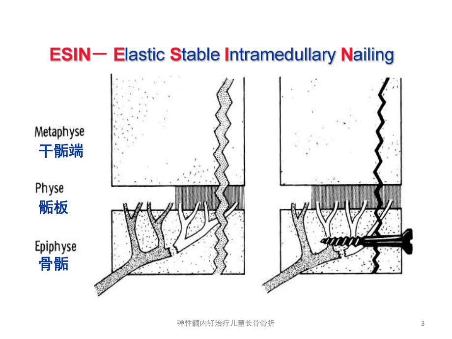 弹性髓内钉治疗儿童长骨骨折培训课件.ppt_第3页