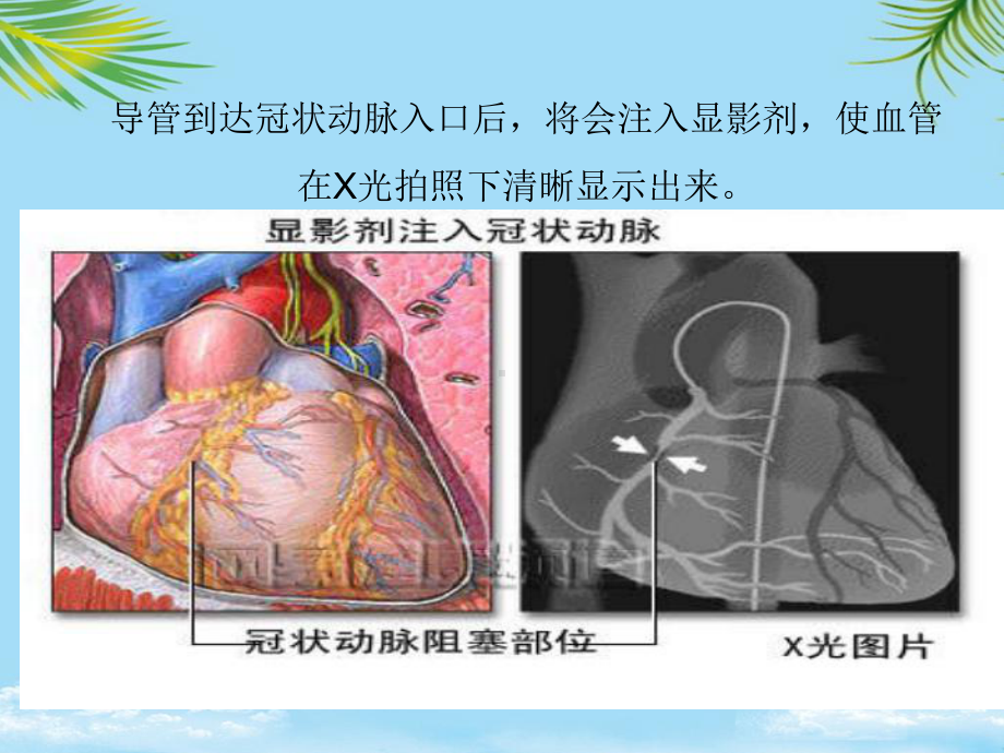 教培用PCI术后并发症原因课件.ppt_第2页