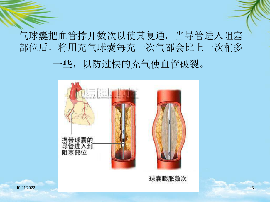 教培用PCI术后并发症原因课件.ppt_第3页