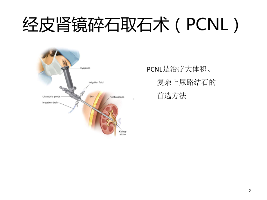 椎旁阻滞麻醉下经皮肾镜碎石术课件.ppt_第2页