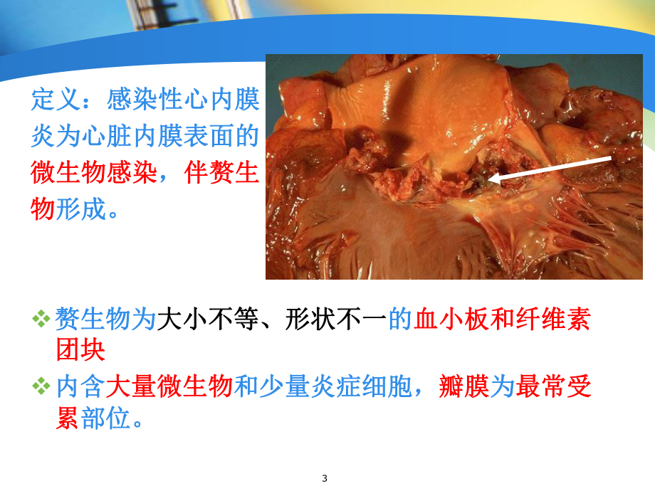 感染性心内膜炎护理课件.ppt_第3页