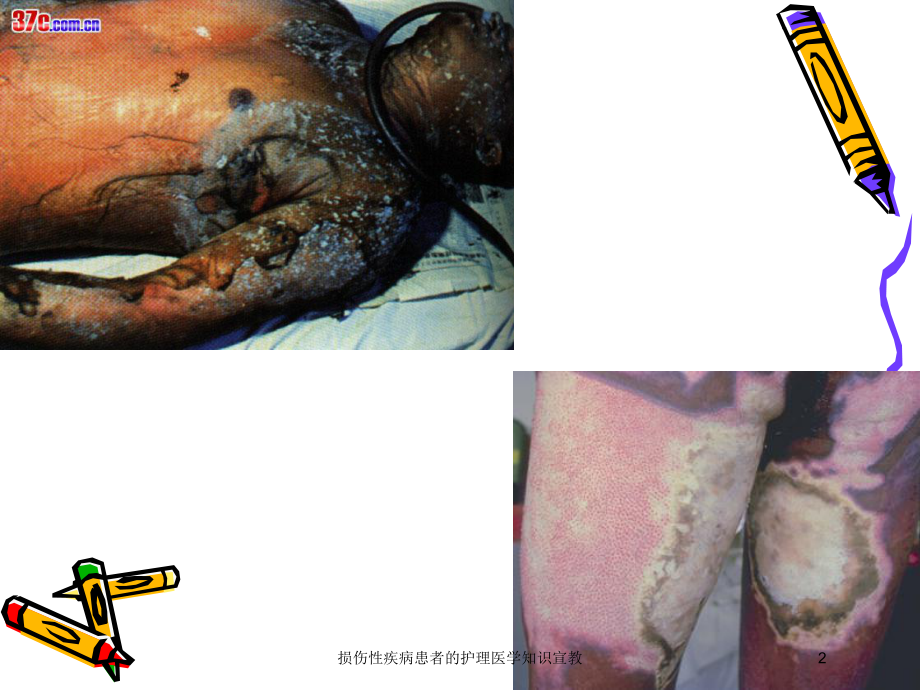 损伤性疾病患者的护理医学知识宣教培训课件.ppt_第2页
