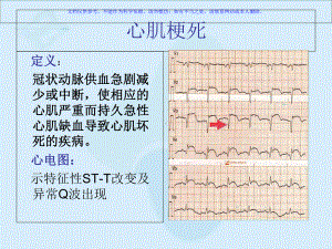 心肌梗死的心电图改变课件.ppt