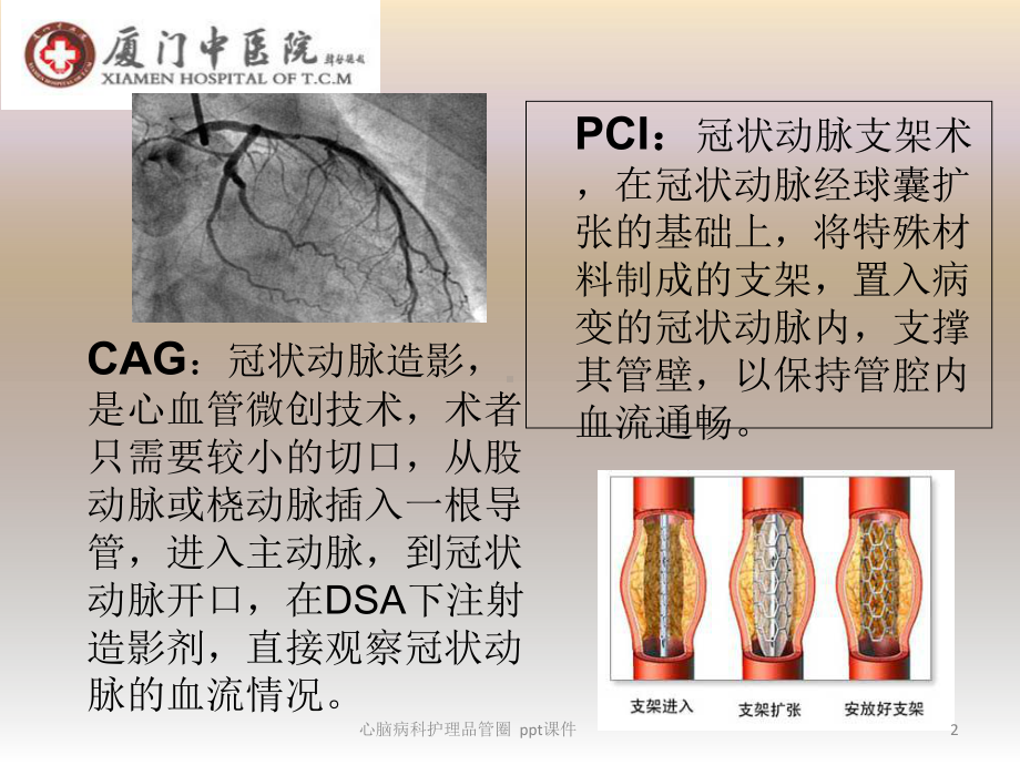 心脑病科护理品管圈-课件.ppt_第2页