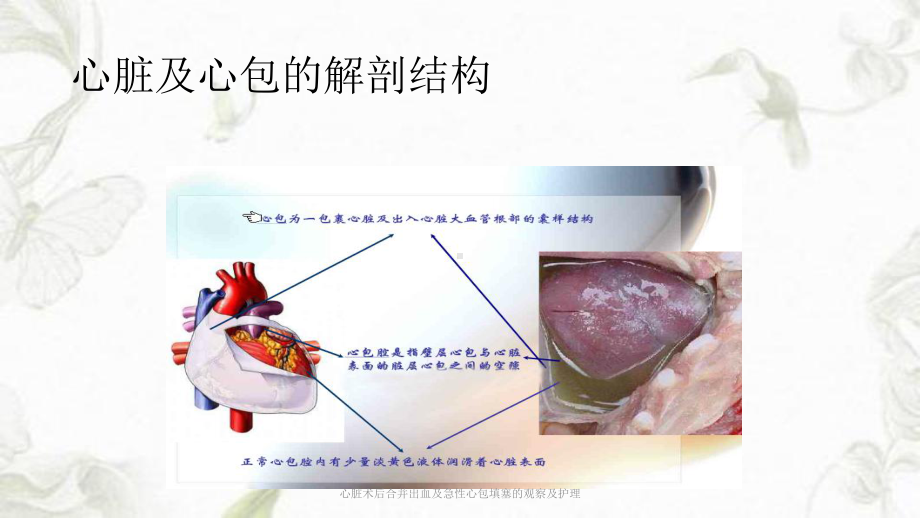 心脏术后合并出血及急性心包填塞的观察及护理课件.ppt_第2页