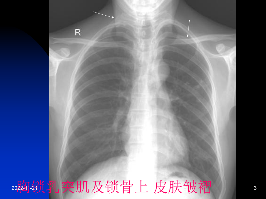 影像学呼吸系统正常影像表现12课件.pptx_第3页