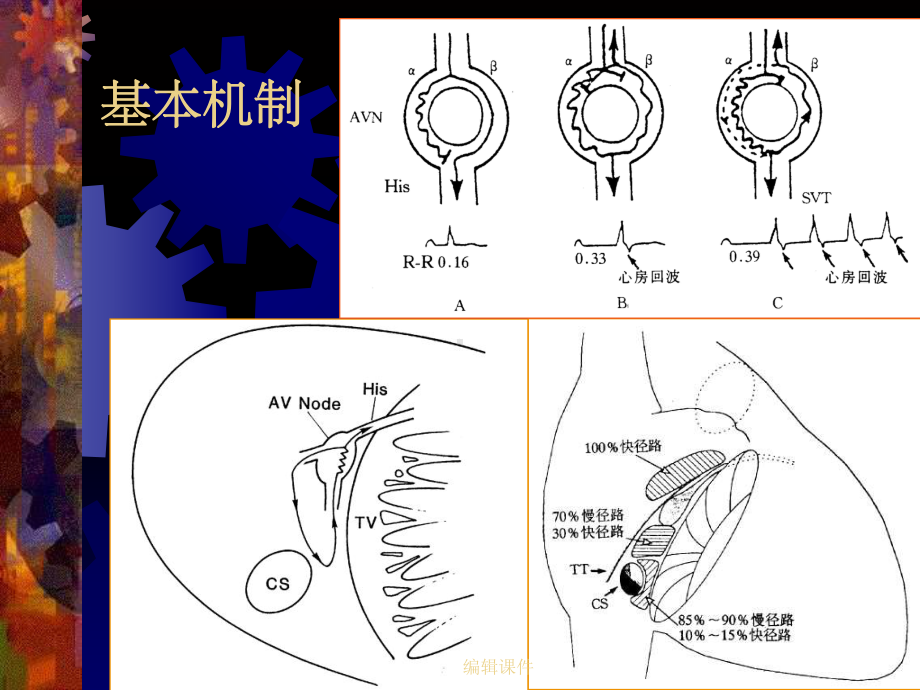 房室结折返心动过速中少见现象的分析课件.ppt_第2页