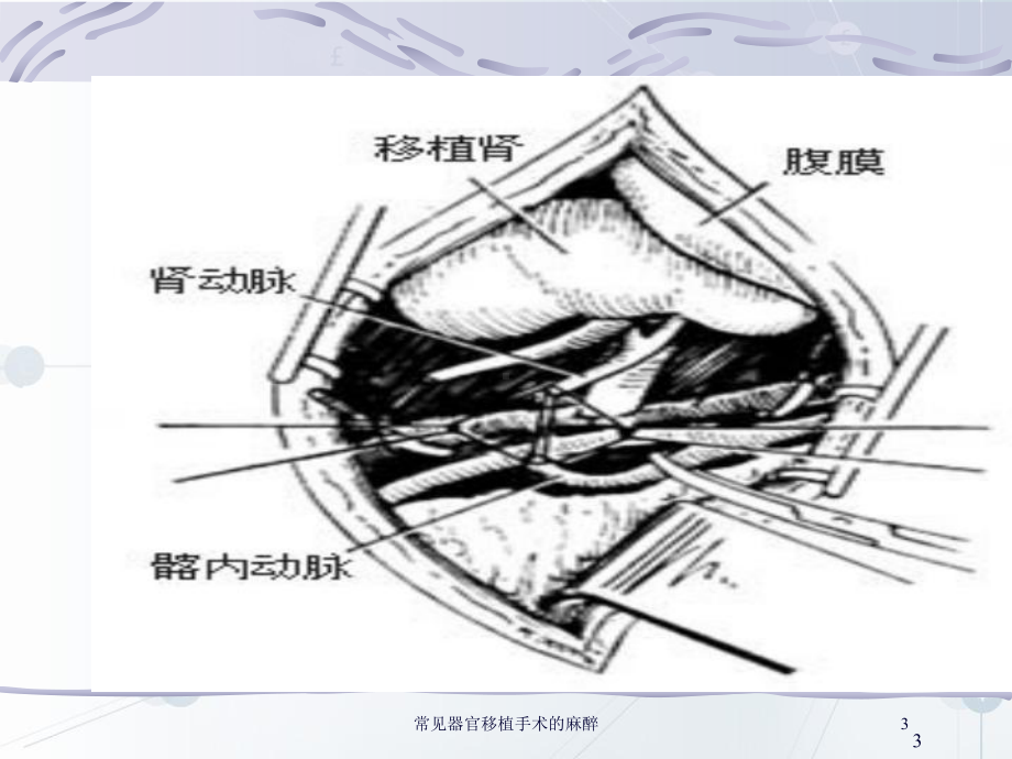 常见器官移植手术的麻醉培训课件.ppt_第3页