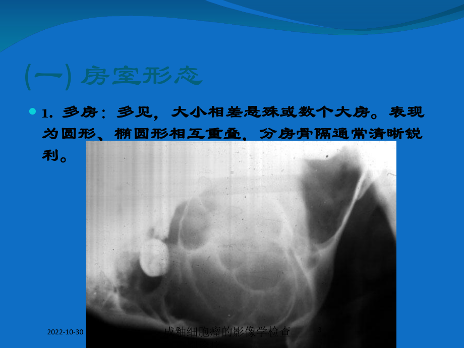 成釉细胞瘤的影像学检查和鉴别诊疗培训课件.ppt_第3页