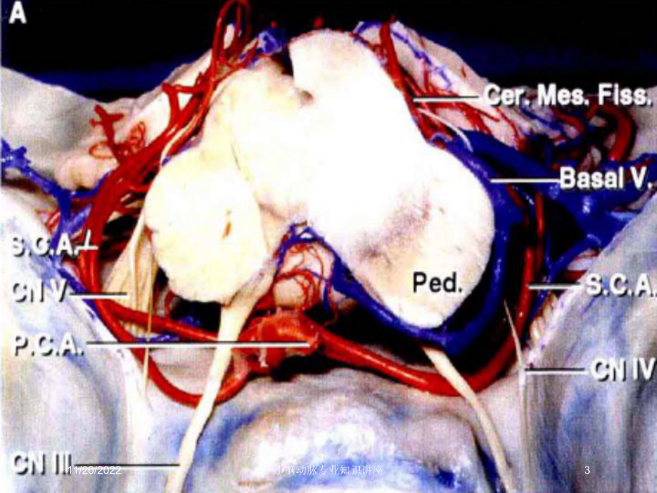 小脑动脉专业知识讲座课件.ppt_第3页