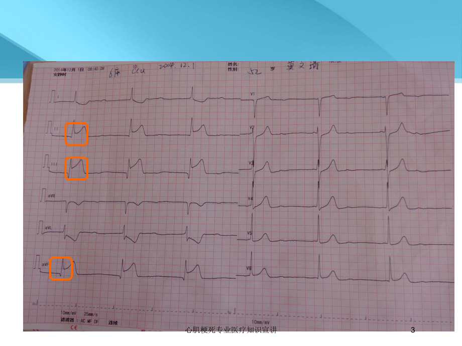心肌梗死专业医疗知识宣讲培训课件.ppt_第3页