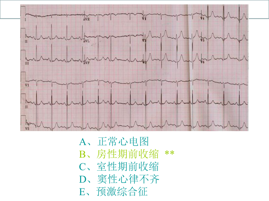 心电图X光片测试题目课件.ppt_第3页