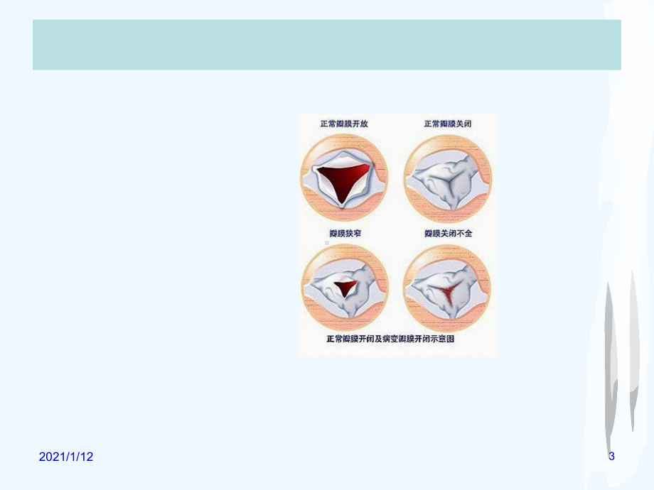 护理查房心脏瓣膜病课件.ppt_第3页