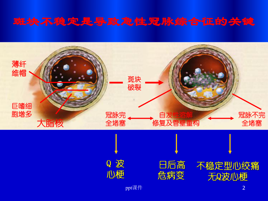 急性心肌梗死--课件.ppt_第2页