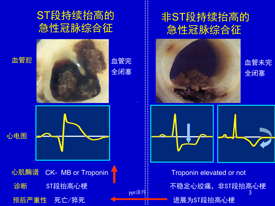 急性心肌梗死--课件.ppt_第3页