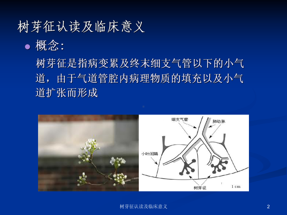 树芽征认读及临床意义培训课件.ppt_第2页