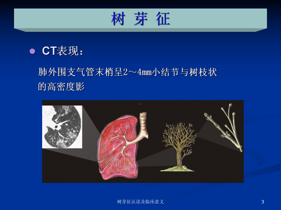 树芽征认读及临床意义培训课件.ppt_第3页