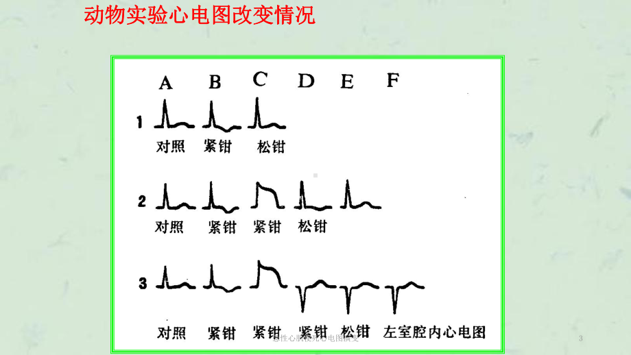 急性心肌梗死心电图演变课件.ppt_第3页