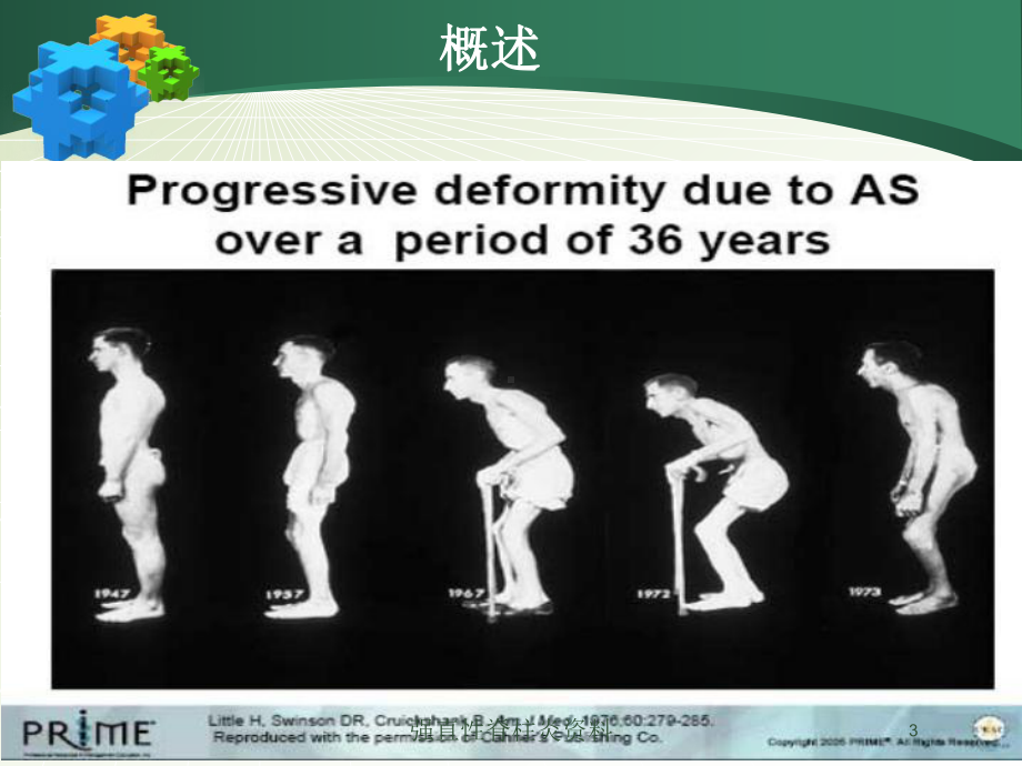 强直性脊柱炎培训课件-3.ppt_第3页