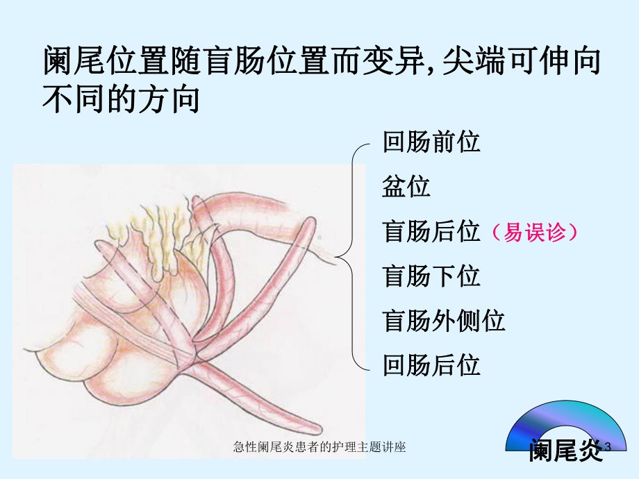 急性阑尾炎患者的护理主题讲座培训课件.ppt_第3页