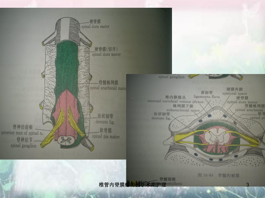 椎管内脊膜瘤的围手术期护理培训课件.ppt_第3页