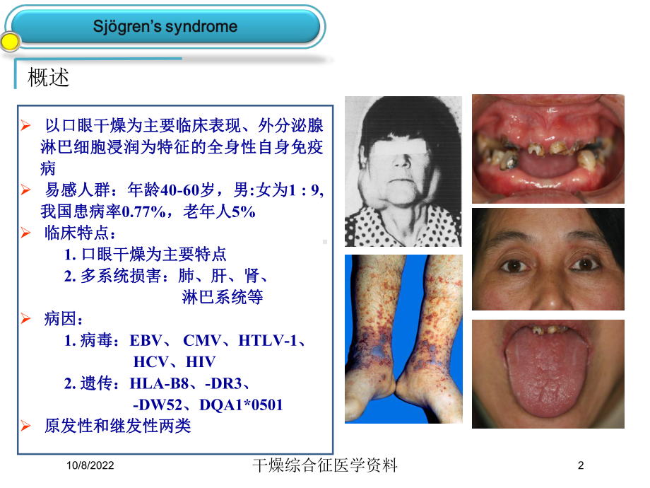 干燥综合征医学培训课件.ppt_第2页