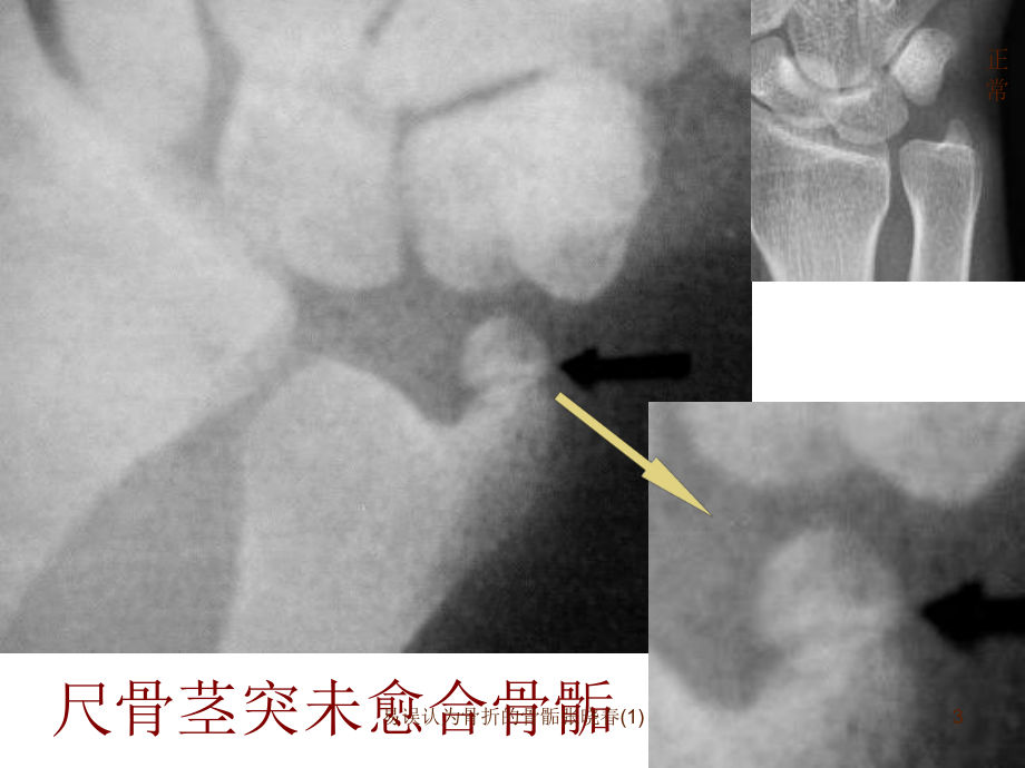 易误认为骨折的骨骺-课件.ppt_第3页