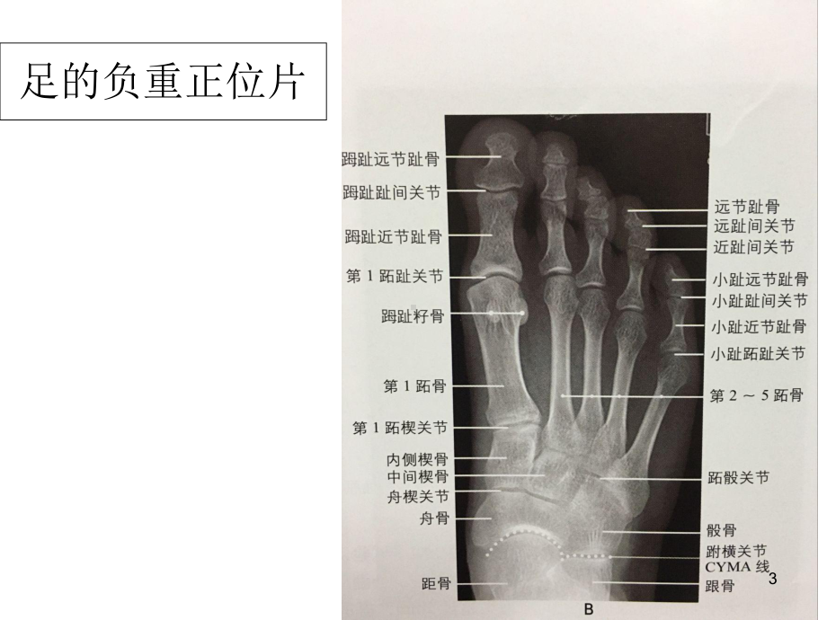 常见足部畸形疾病X线评估参考课件.ppt_第3页