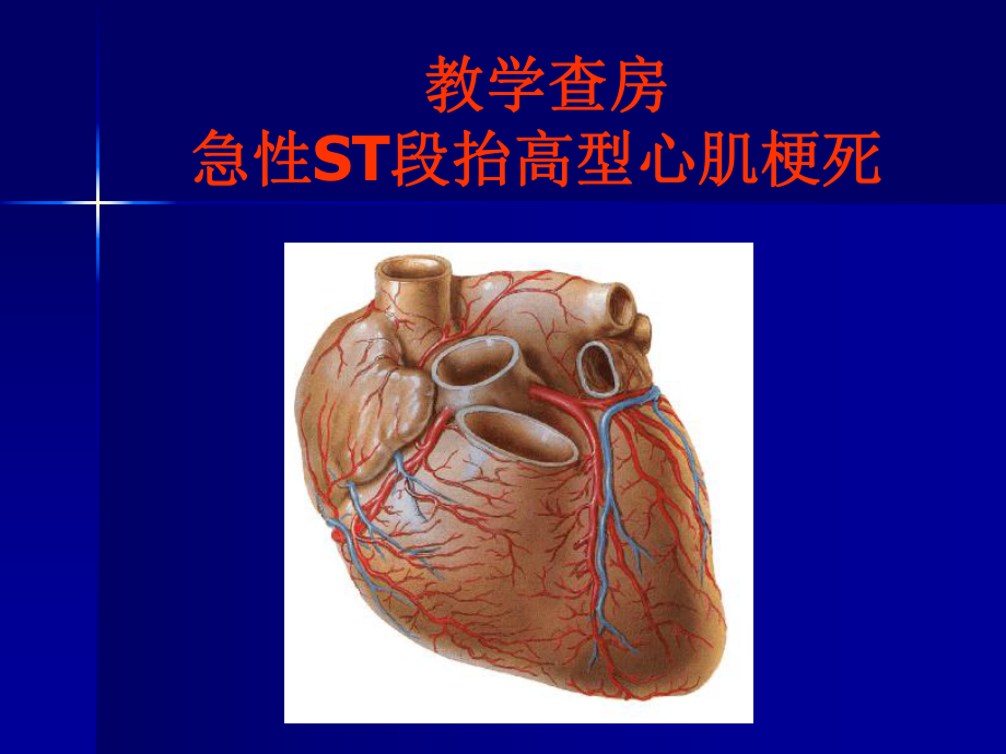 教学查房(急性心肌梗死)优秀课件.ppt_第1页