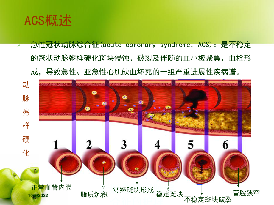 新版急性冠脉综合征的护理培训课件.ppt_第1页