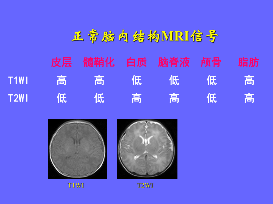 新生儿头部磁共振成像-课件.ppt_第3页