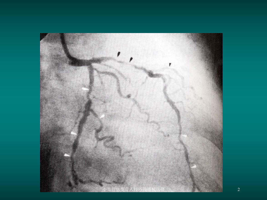 小血管病变介入技巧及器械选择培训课件.ppt_第2页