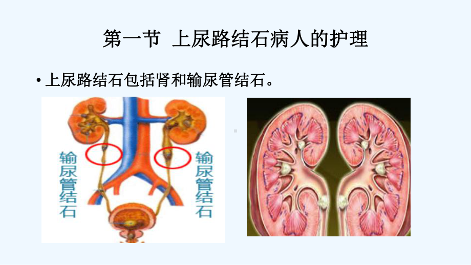 尿石症病人的护理课件.pptx_第3页