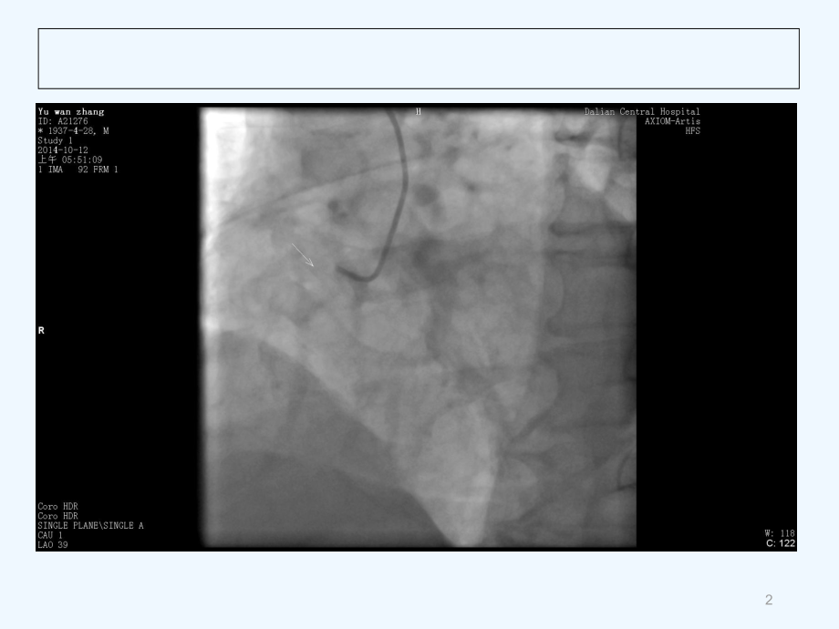 时家义急性冠脉综合征介入治疗策略课件.ppt_第2页